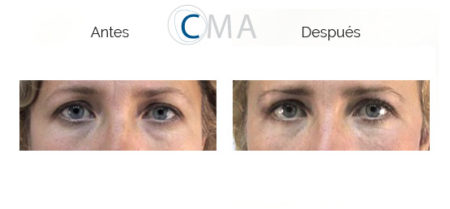 Blefaroplastia O Cirug A De P Rpados Cl Nicas Mato Ansorena