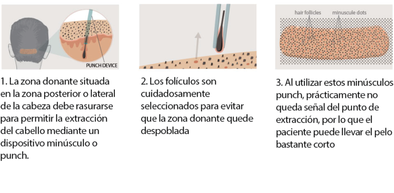 Trasplante Capilar Microinjertos E Injertos En Madrid